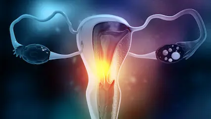 Tratamiento de lesiones intraepiteliales de alto grado por medio de un dispositivo vaginal
