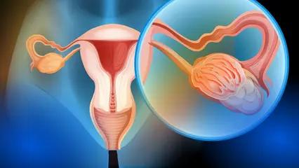 Oncobiosis y cáncer de ovario. A propósito del 8 de mayo: “Día mundial contra el cáncer de ovario”