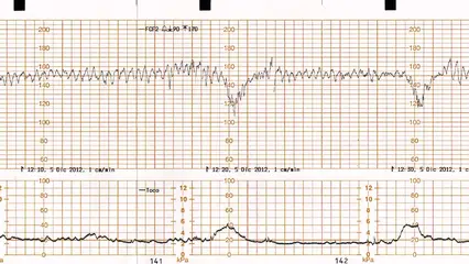 Suplementación con oxígeno en el escenario de un registro cardiotocográfico categoría II o III