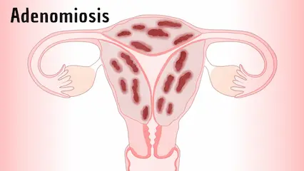 Actualidades en el tratamiento de la Adenomiosis