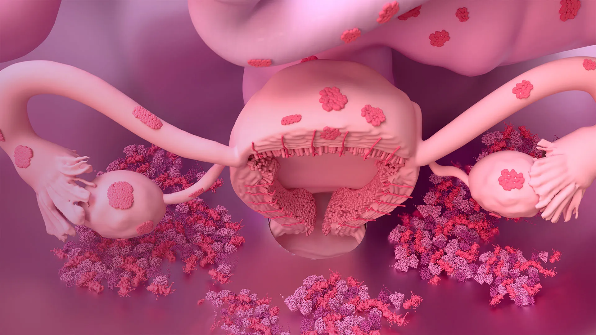 Endometriosis e Inmunidad: Claves para una Terapéutica Personalizada