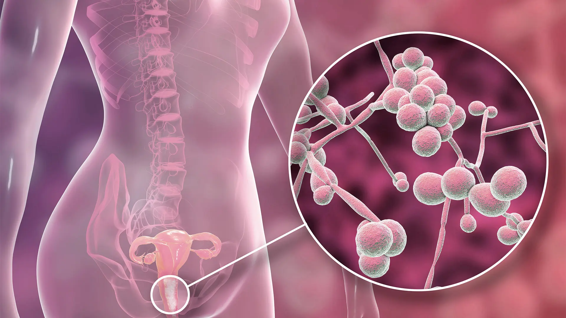 Infecciones vaginales: ¿Qué perfil de paciente con necesita un esquema terapéutico corto y completo?