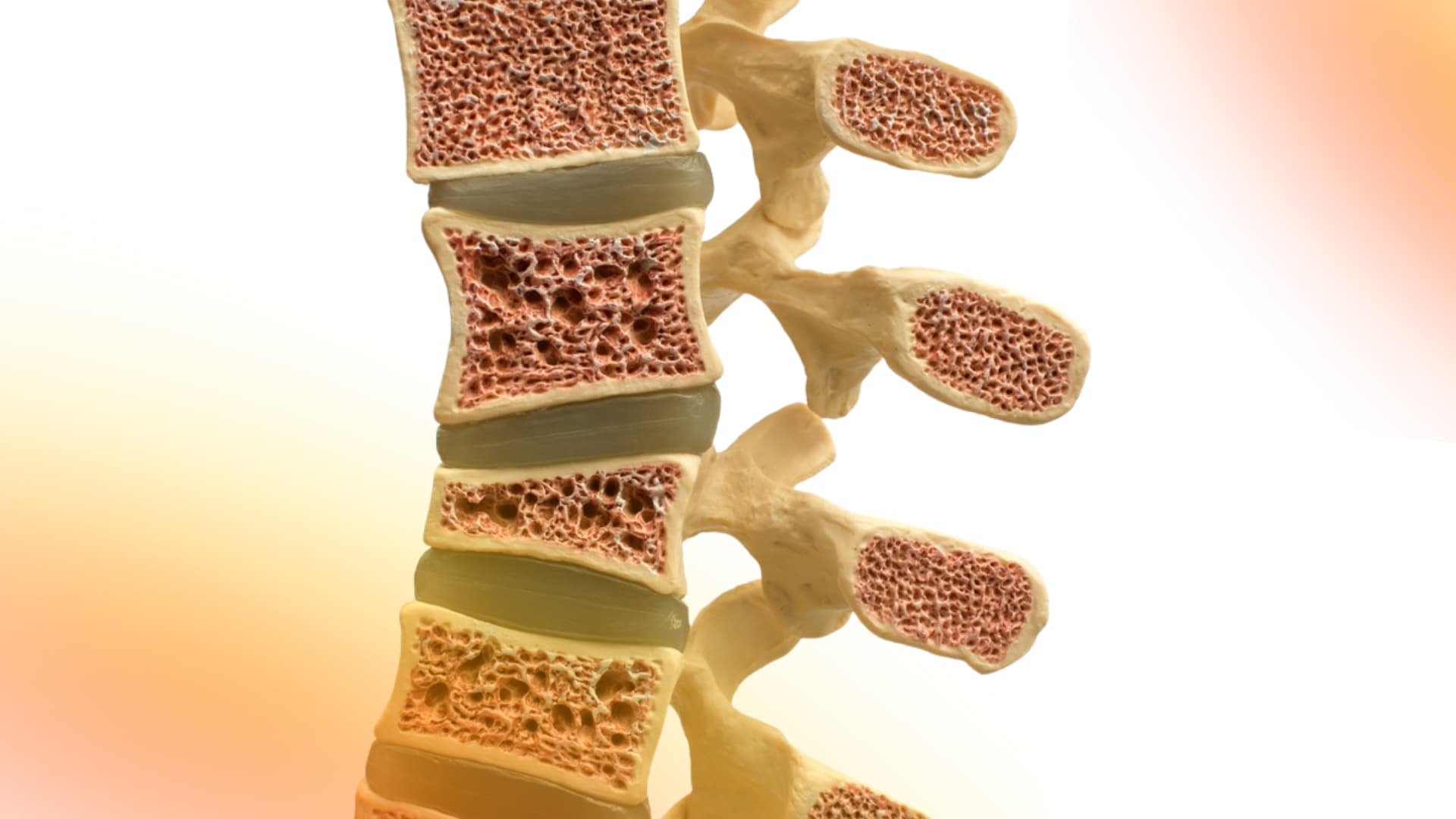 La importancia de la suplementación con calcio y vitamina D para la prevención de fractura osteoporótica