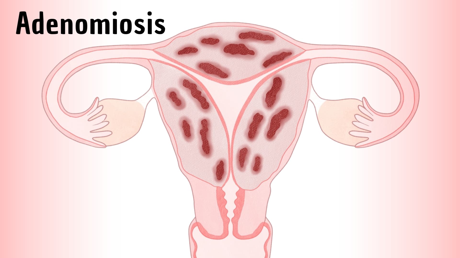 Actualidades en el tratamiento de la Adenomiosis