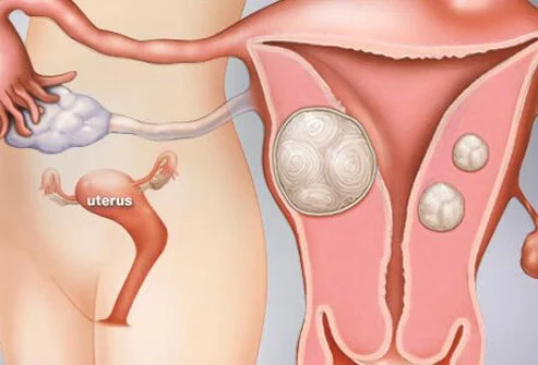 Otros beneficios del inositol: disminución del tamaño de los miomas uterinos.